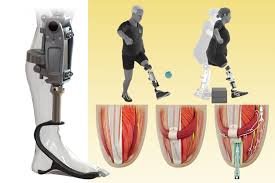You are currently viewing BIONIC PROSTHETIC LEG COST EXPLAINED